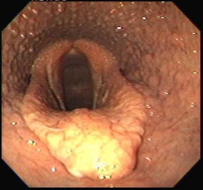 Endoscopy