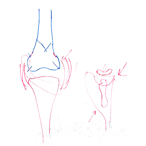 Murray procedure drawing